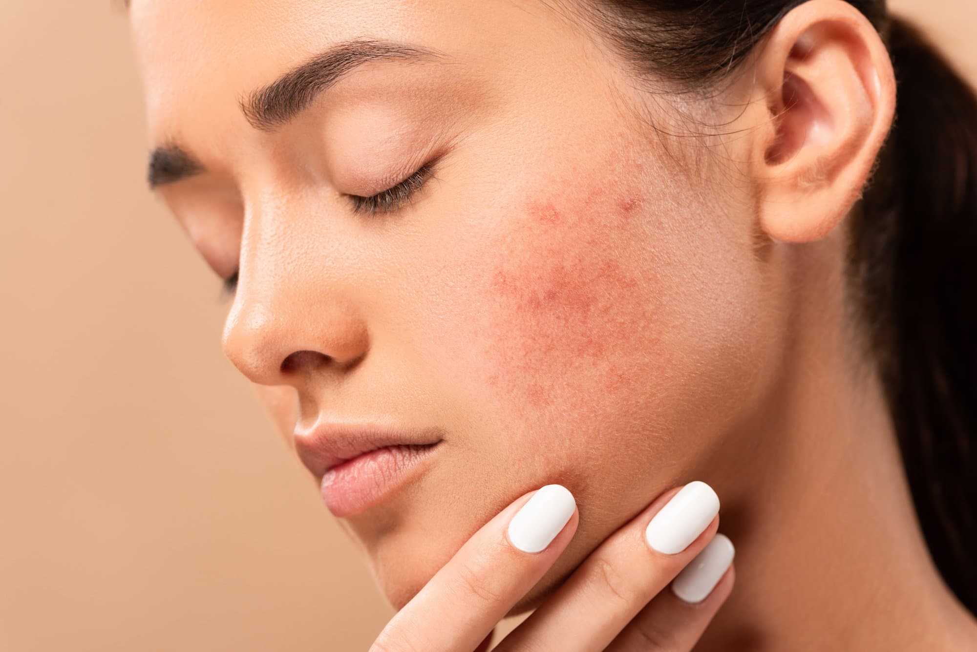 Acne & Acne Scarring