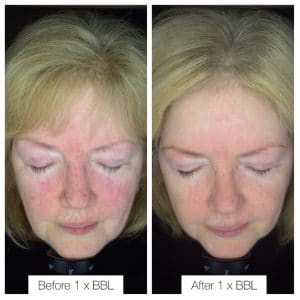 Before&after BBL treatment Edgehill clinic Jade Cosmetics
