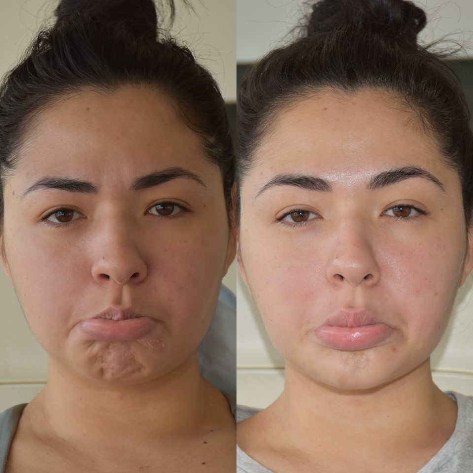 Antiwrinkle chin before after