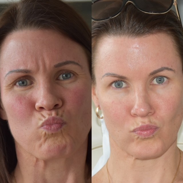 Antiwrinkle lips before after