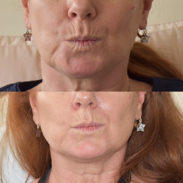 Antiwrinkle lips before after