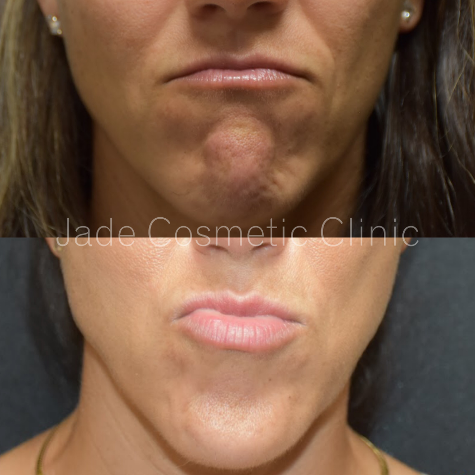 Antiwrinkle chin before after