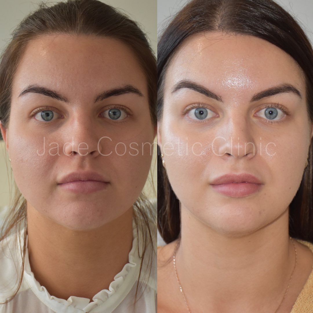 Facial Slimming with Anti-Wrinkle Injections – M1 Med Beauty Australia