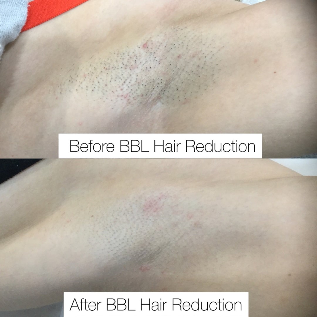 BBL Hair Reduction
