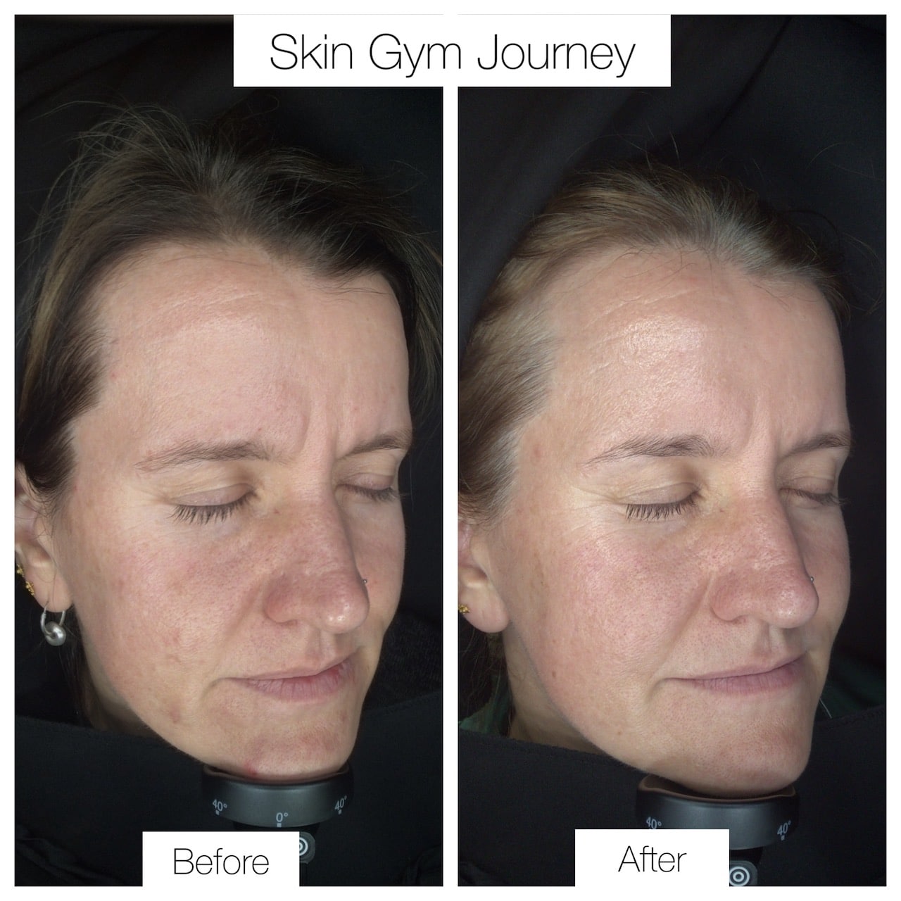 skin gym before after