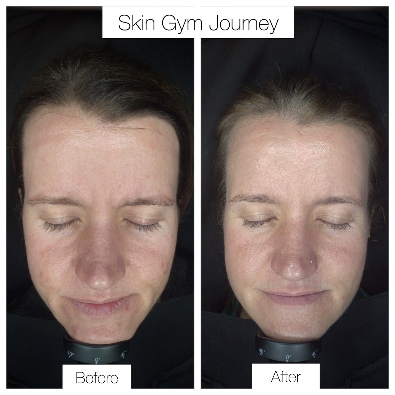 skin gym before after