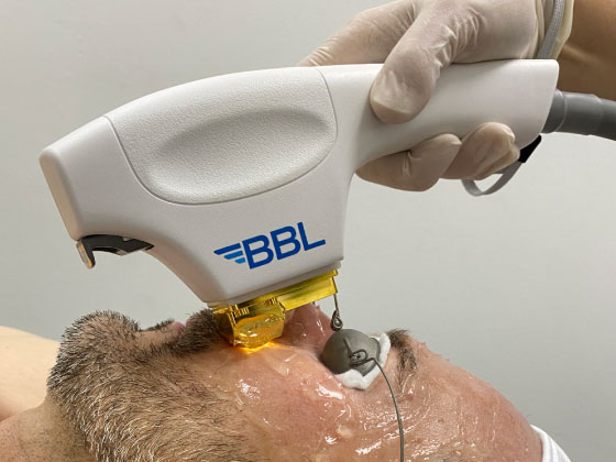 Broadband Light (BBL Laser) Therapy