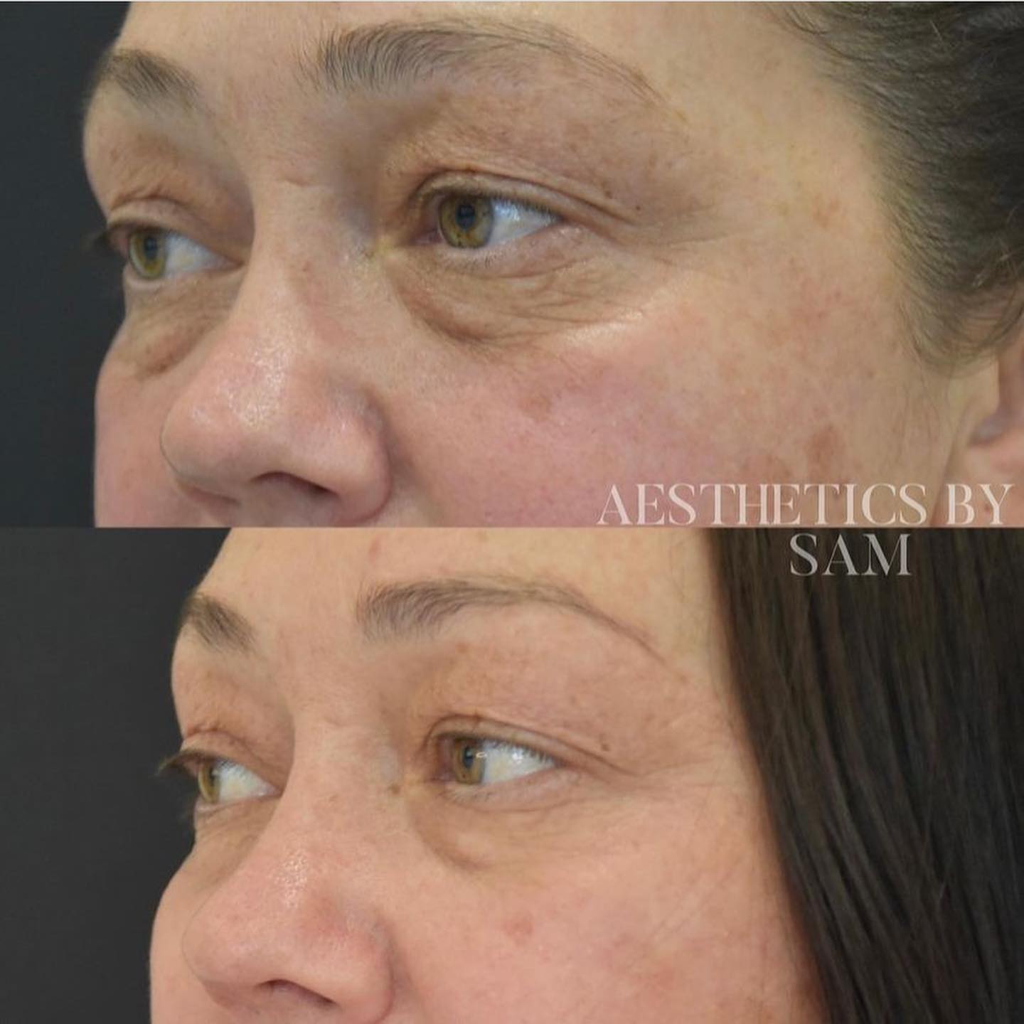 Dermal Fillers Tear Trough