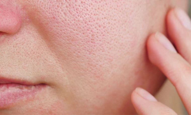 Enlarged Pores