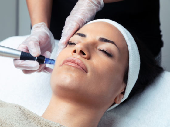 Skin Needling