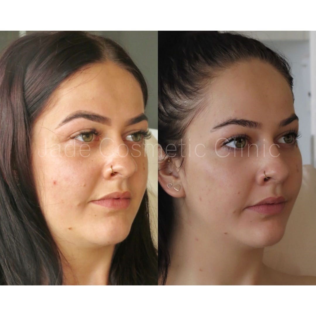 full face filler before after