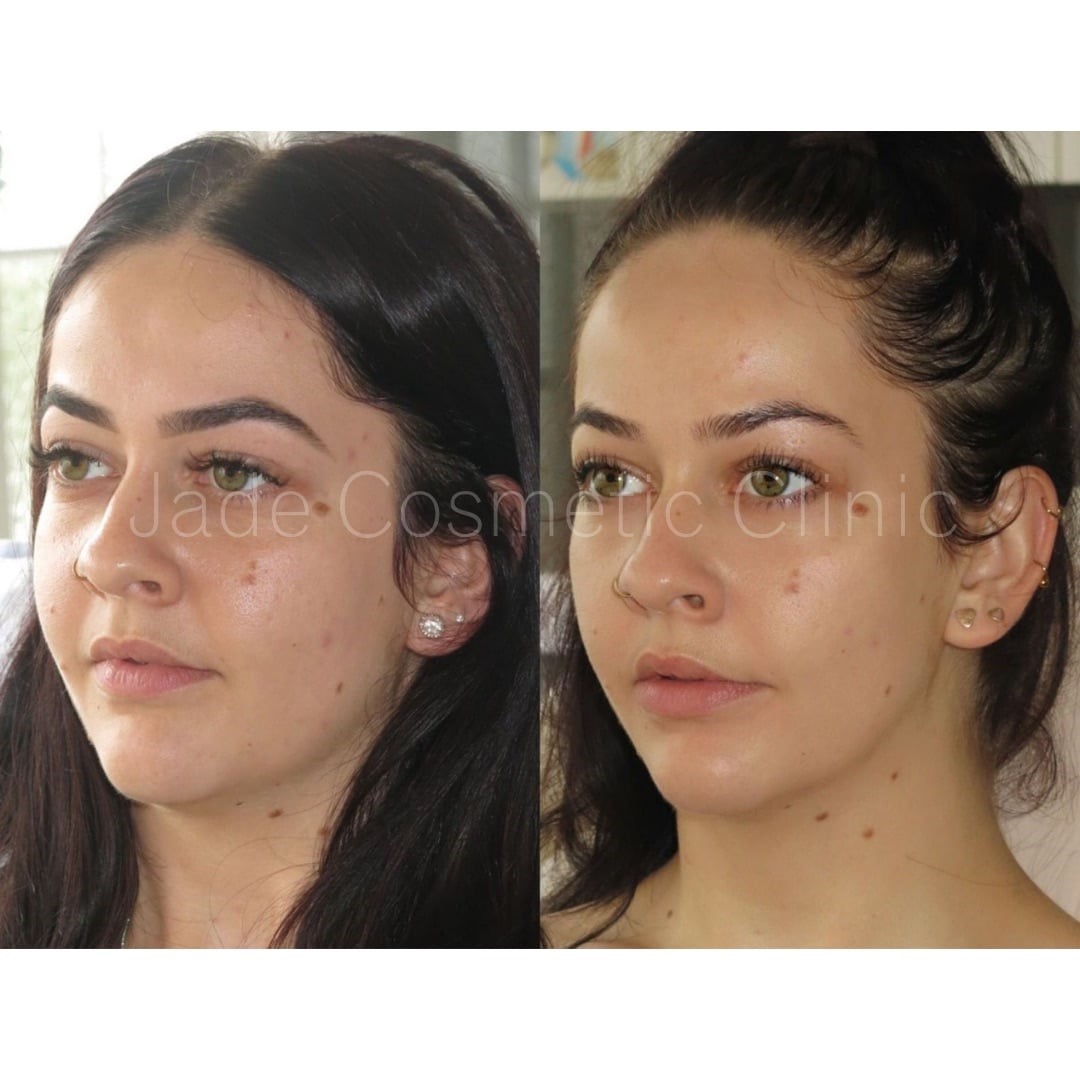 full face filler before after