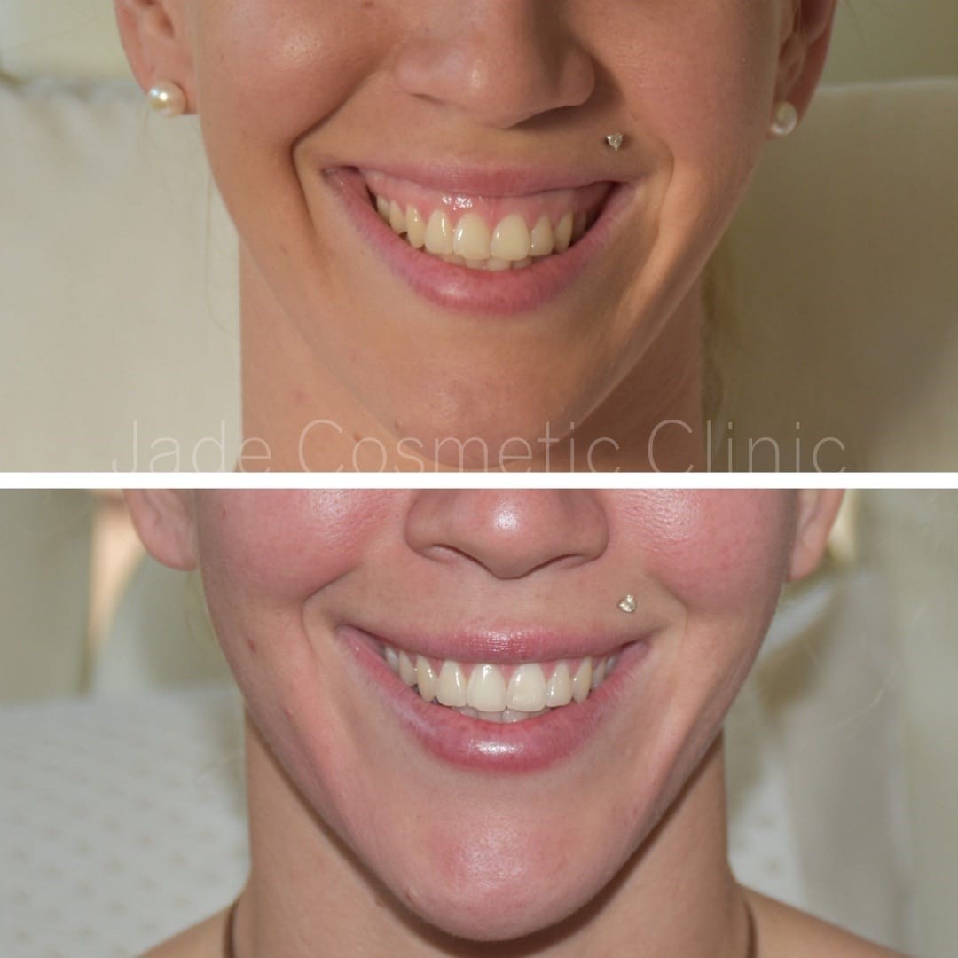 gummy smile botox