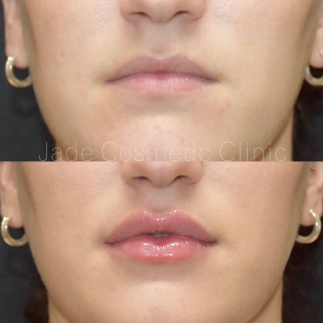 lip fillers before after