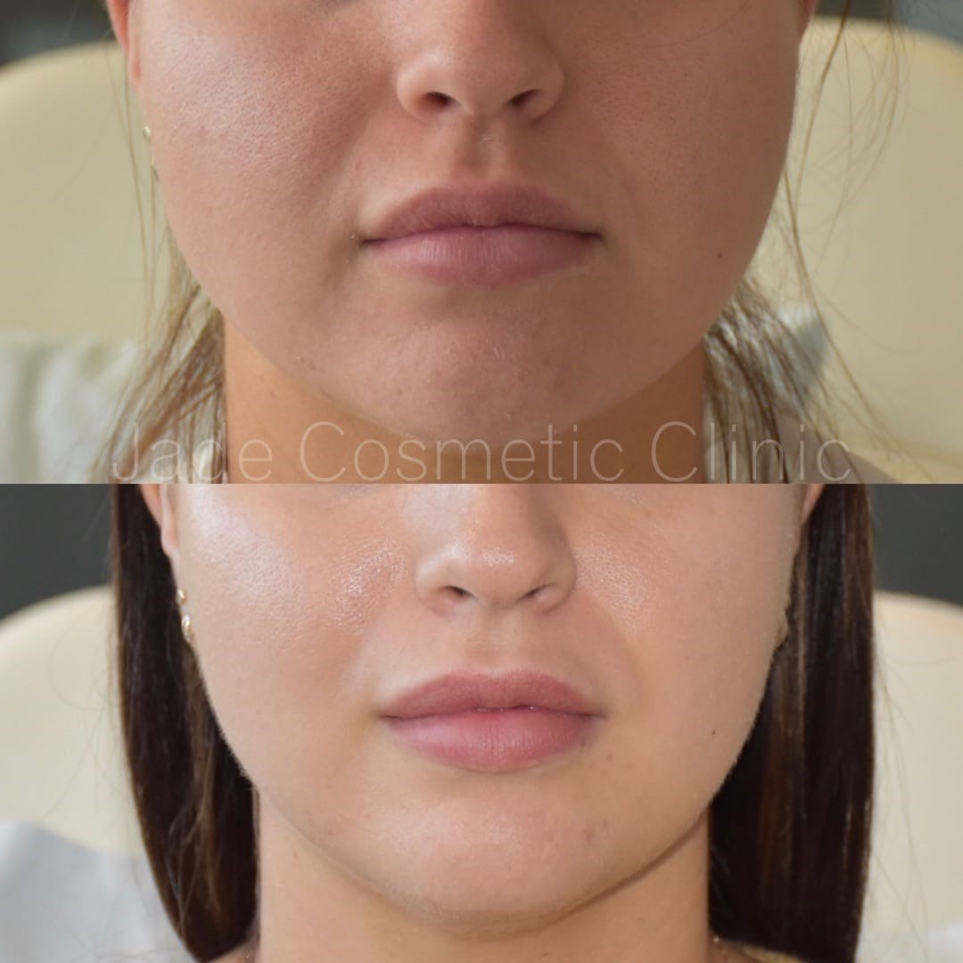 masseter botox facial slimming