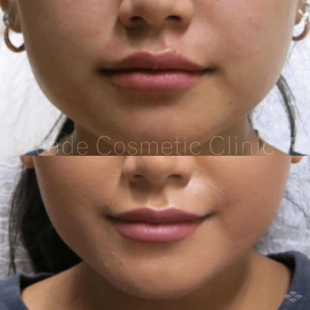 masseter botox facial slimming