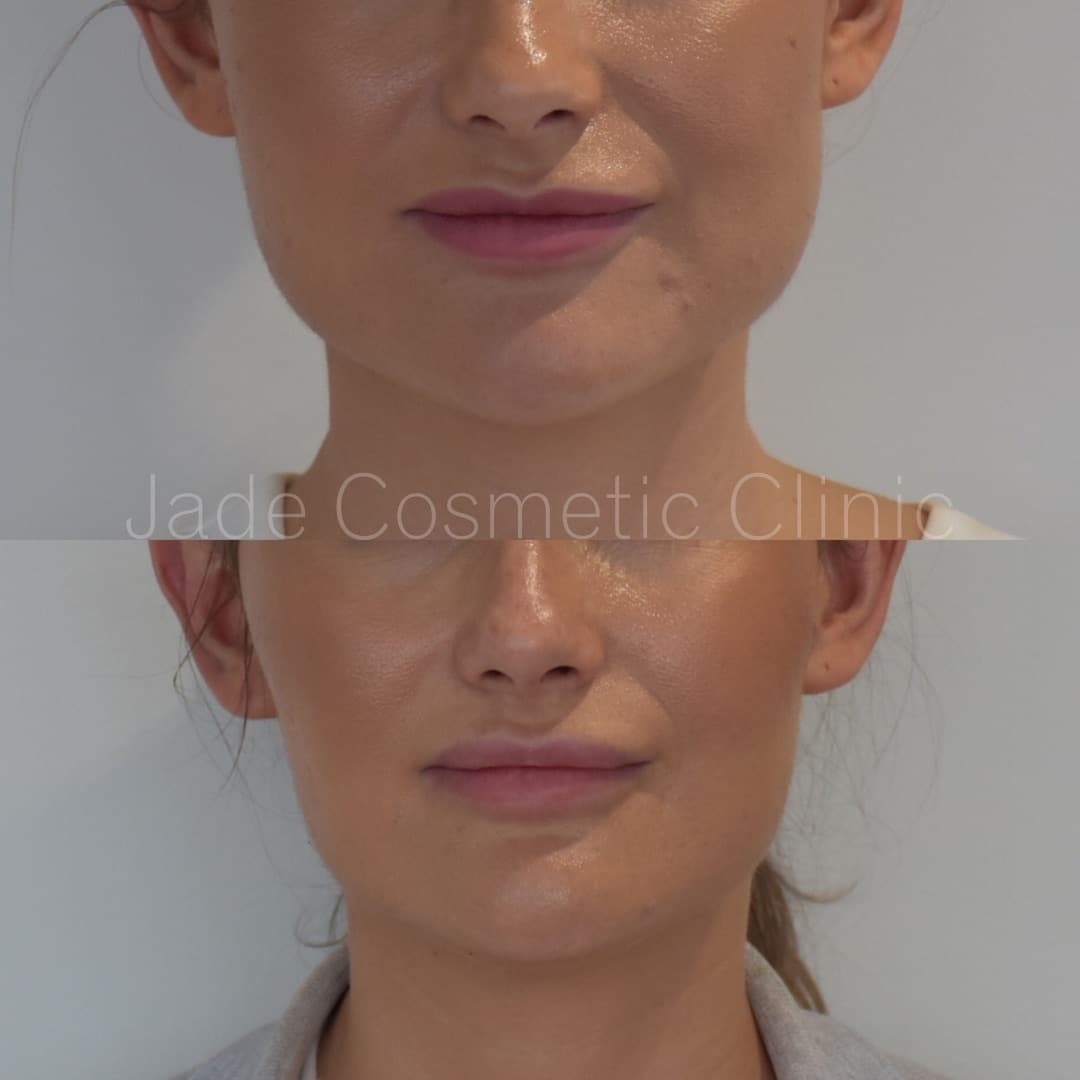 masseter botox facial slimming