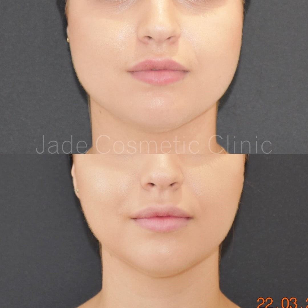 masseter botox facial slimming