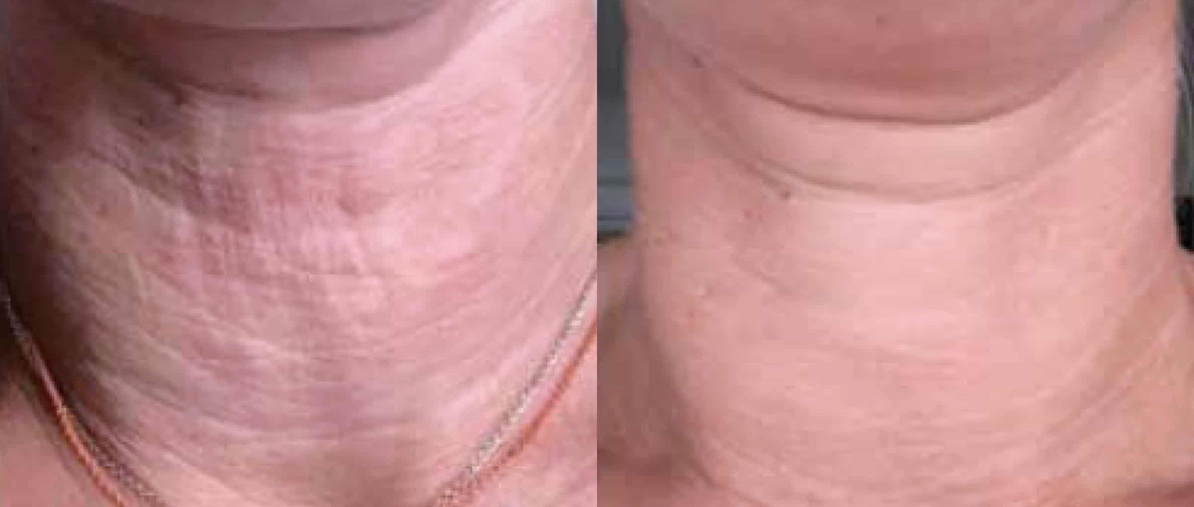 skin boosters before after