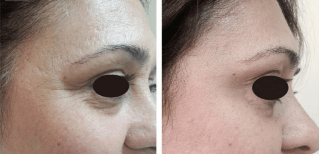 skin rejuvenation before after
