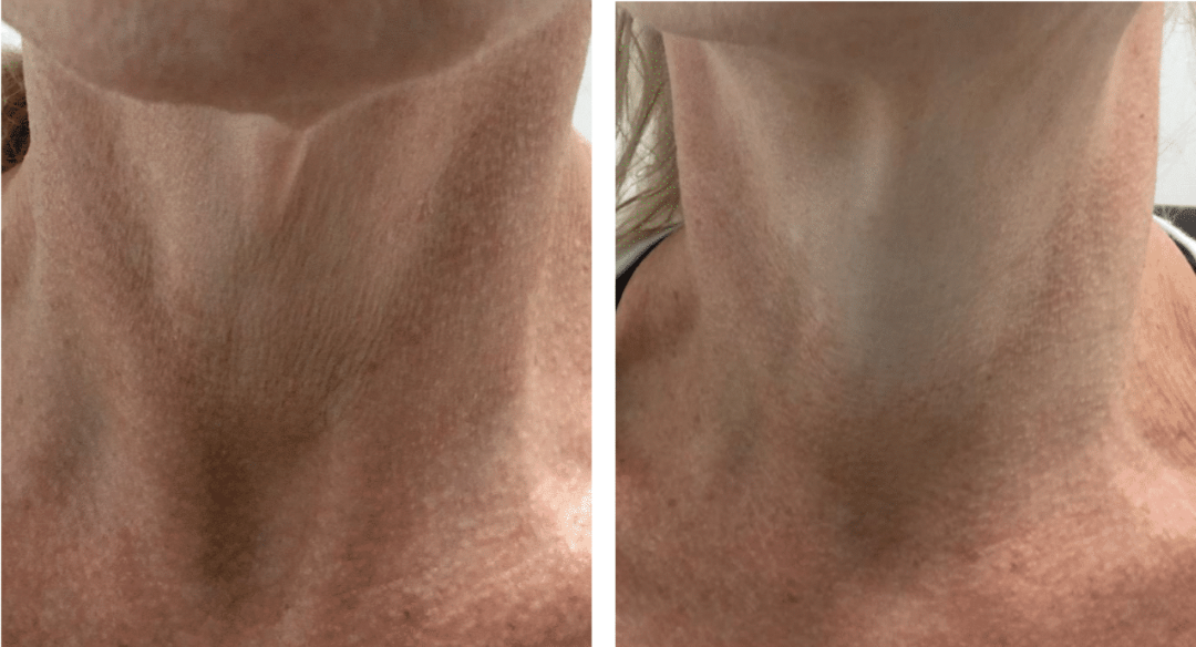 skin rejuvenation before after