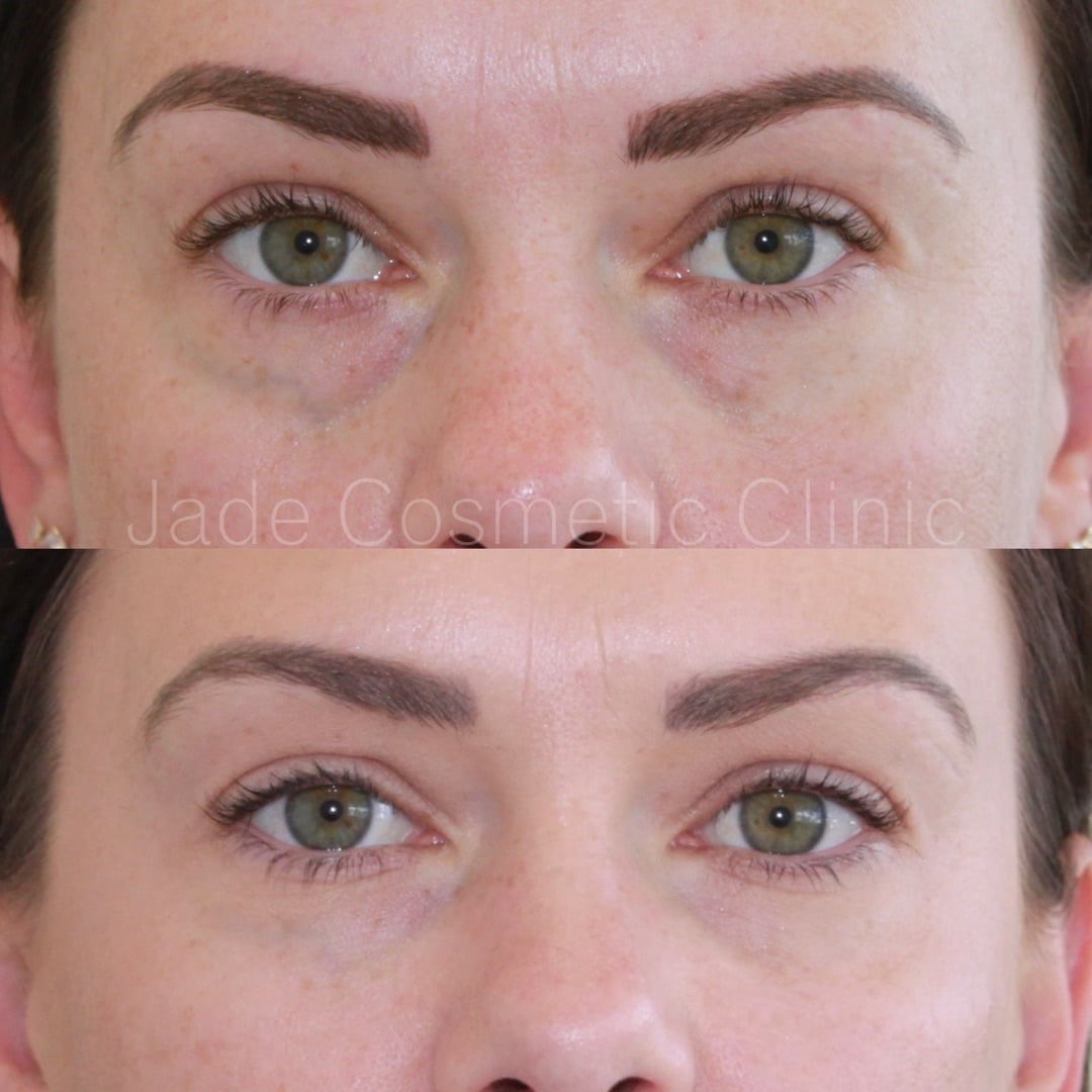 tear trough under eyes filler before after Dermal Fillers