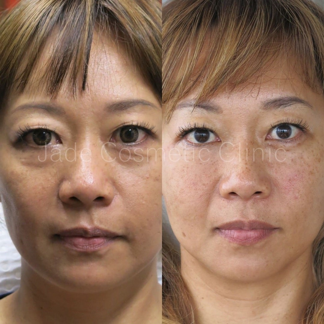 tear trough under eyes filler before after Dermal Fillers