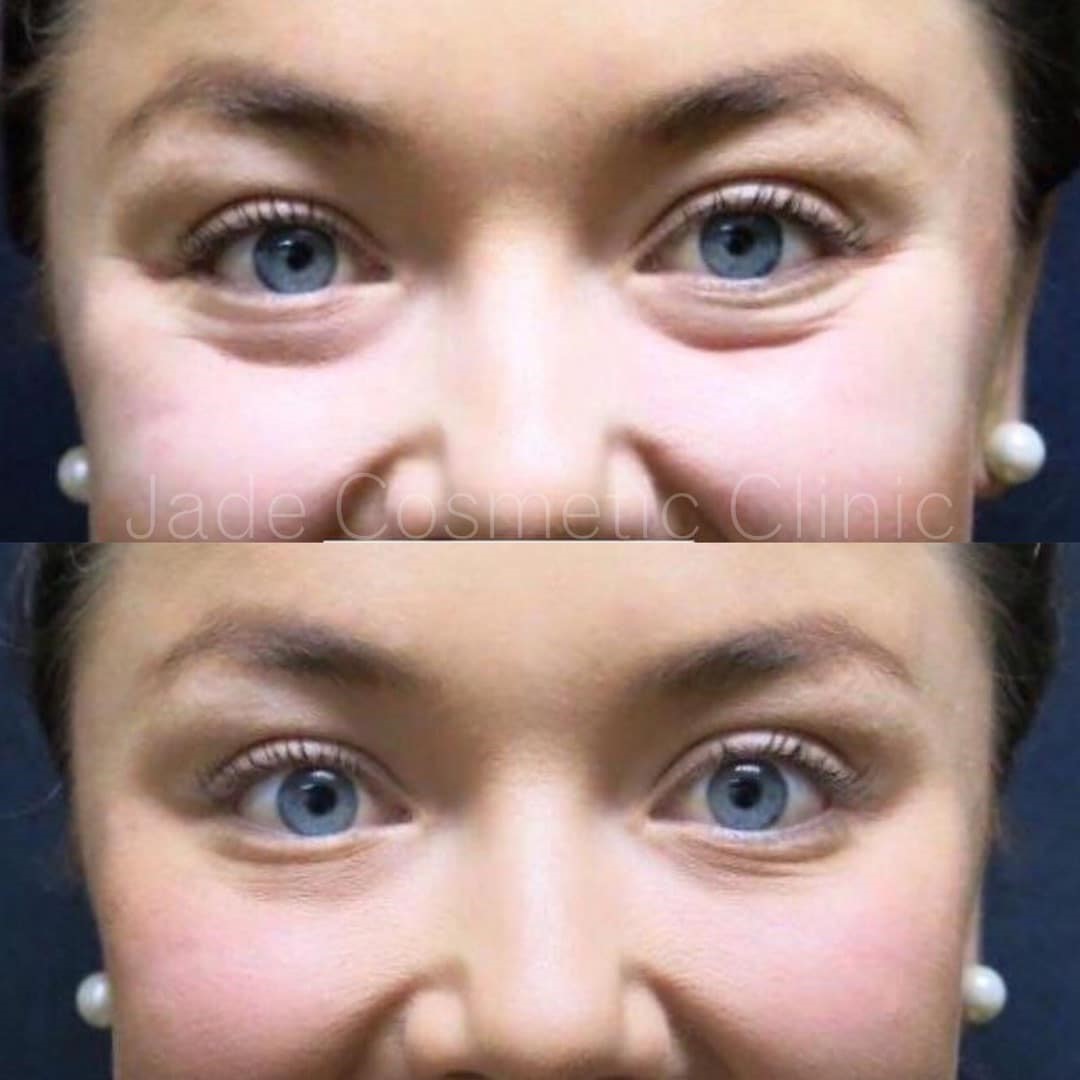 Under Eye Fillers - Before & After Results at Skinly