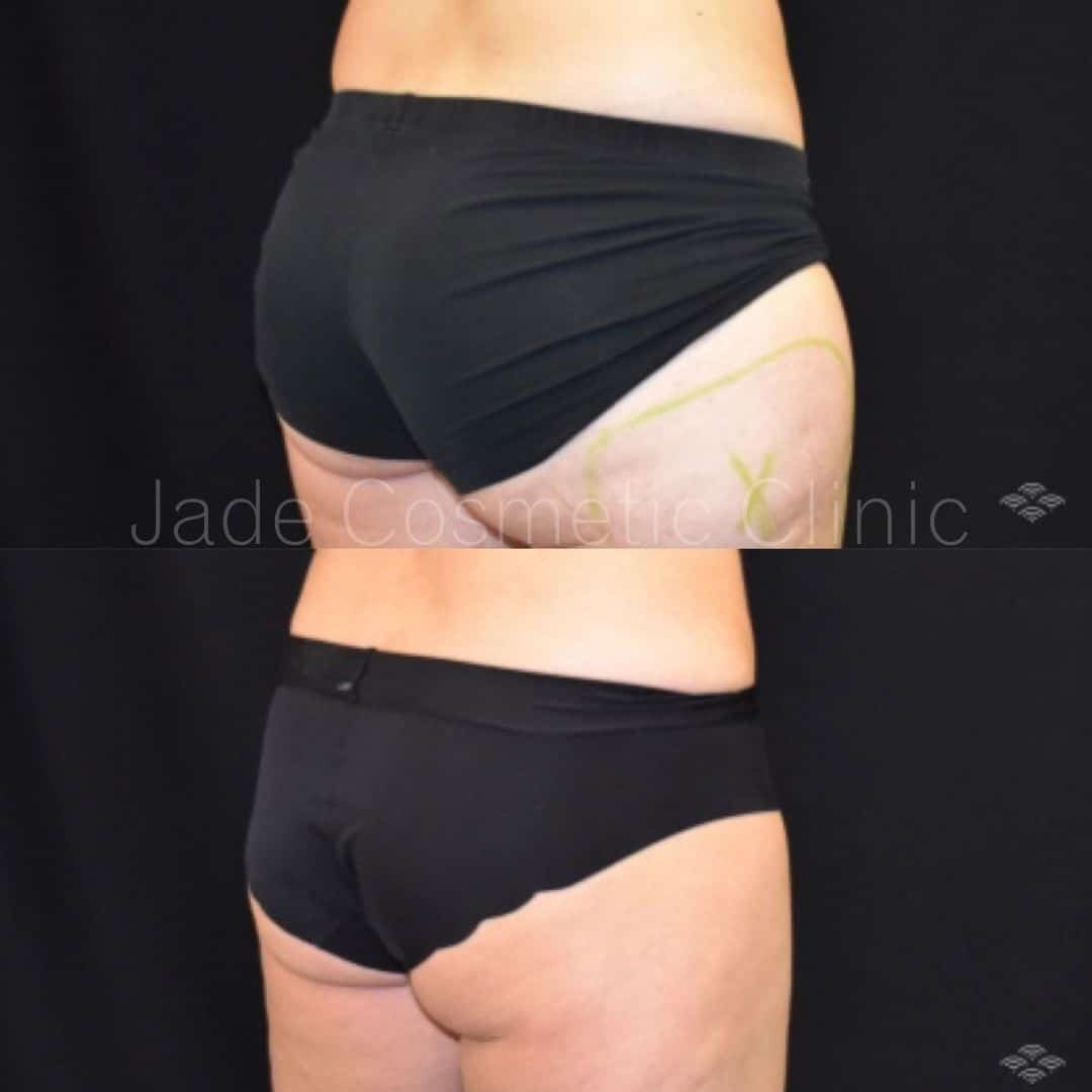 CoolSculpting Outer Thighs