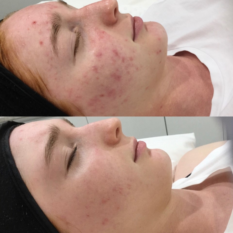 Skin Peels and LED before and after