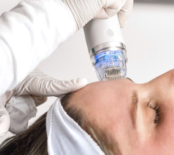 rf microneedling brisbane