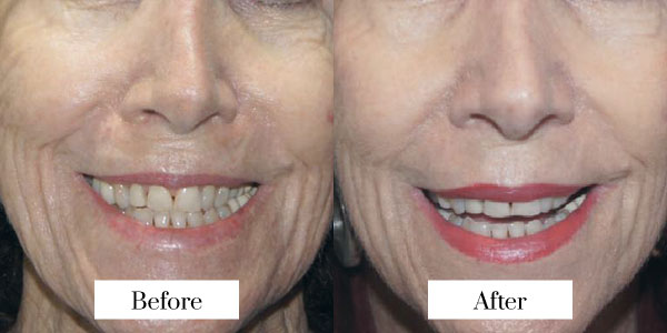 secret rf micro needling before after
