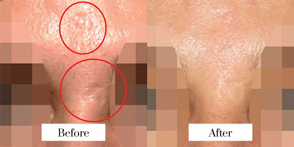 secret rf micro needling before after
