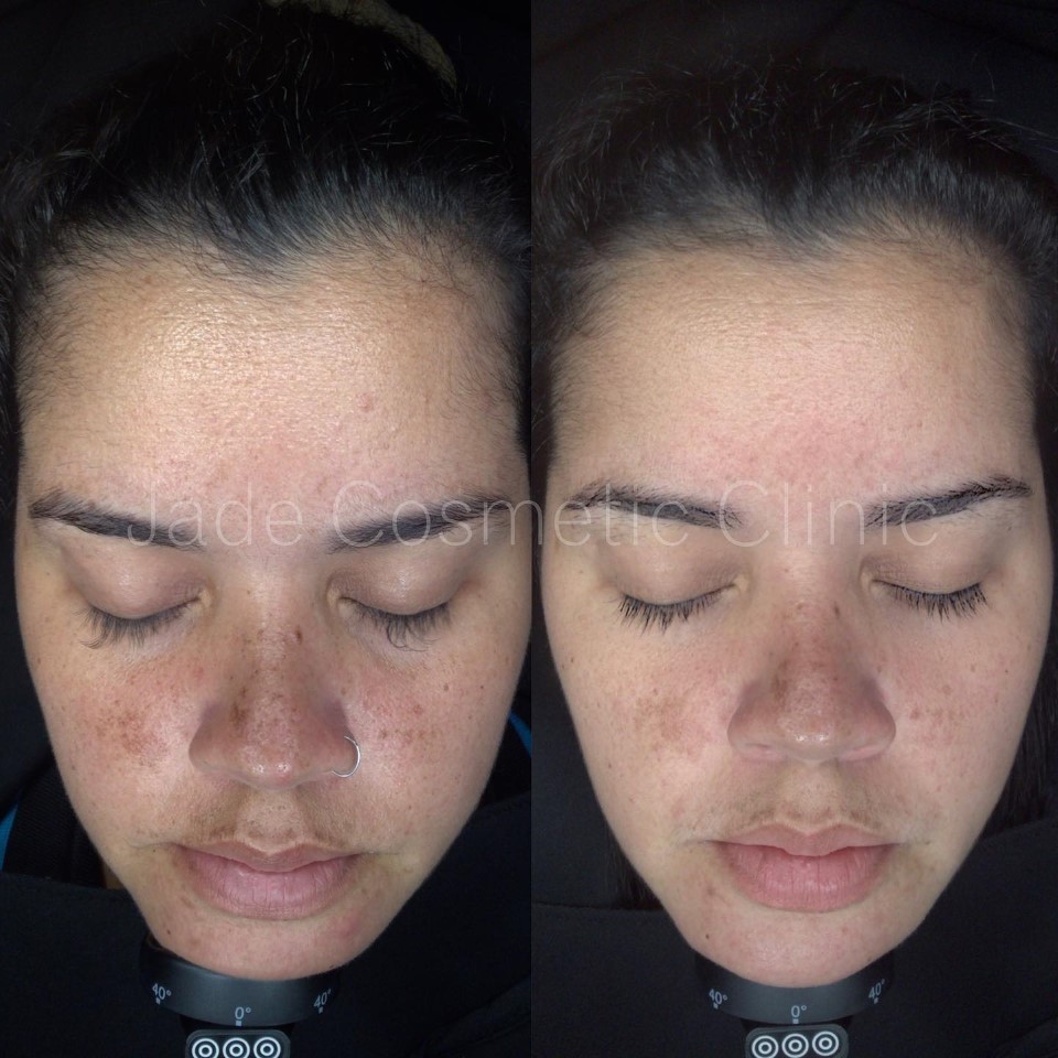 skin peels before and after