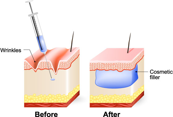 dermal filler injections trinity beach jade Cosmetic Clinic