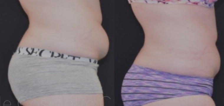 coolsculpting trinity beach before and after